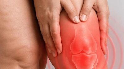 Prof. Dr. Ahmet Karacalar, lipödemin diz eklemlerinde yük artışı ve